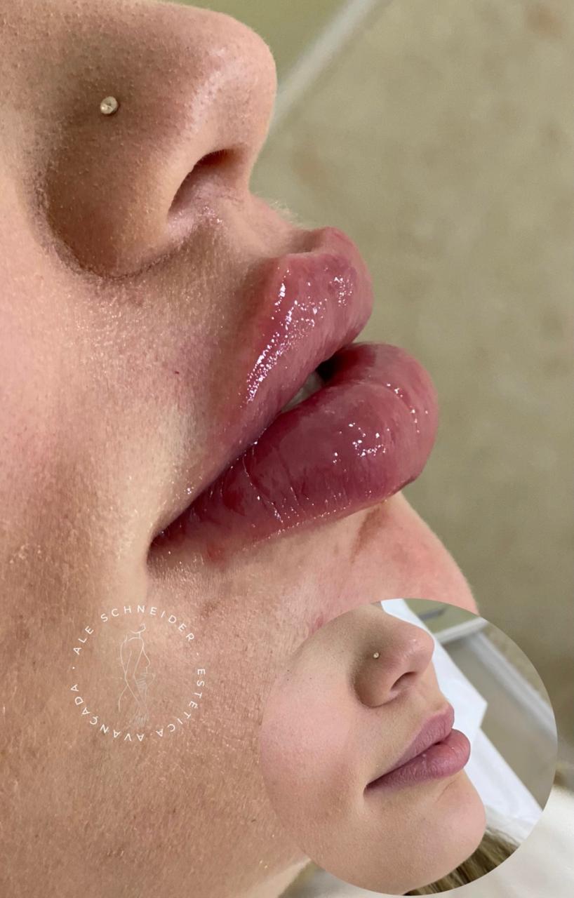 Harmonização labial
