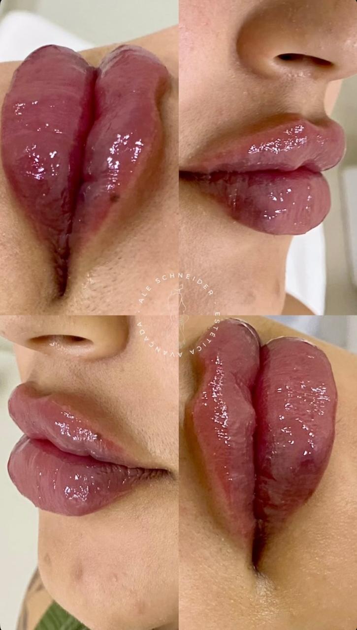 Harmonização labial